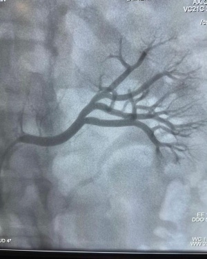 Técnica de denervação renal interrompe sinais nervosos para controlar hipertensão em pacientes cardíacos. Foto: Cortesia