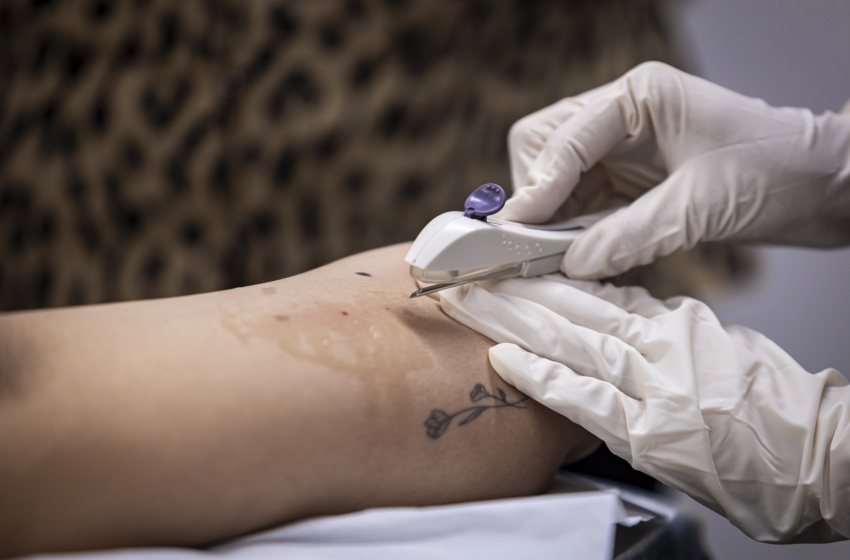 Em dois meses, Implanon é disponibilizado para mais de 600 mulheres